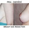 Modelace povadlých prsou