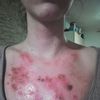 Biostimulační laser na popáleniny po chemickém peelingu