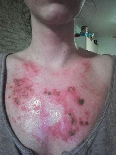 Biostimulační laser na popáleniny po chemickém peelingu