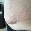 Abdominoplastika nebo jiné řešení