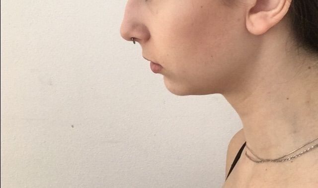 Řešení nerovnosti obličeje a podbradku