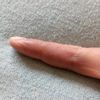 Fialový a oteklý prst ruky bez příčiny - 13587