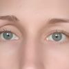 Operace jednoho očního víčka - ptoza - 13603