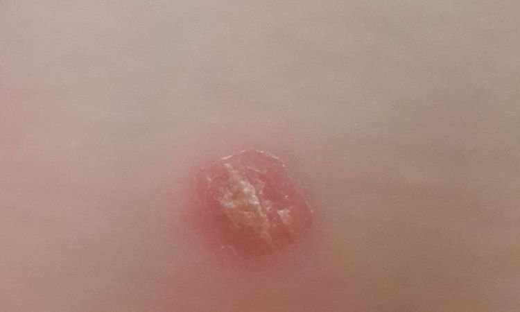 Zvětšení a začervenání pihy a suché šupiny na ní - 13604