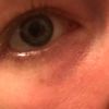 Jak odstranit modrofialové kruhy pod očima? - 13641