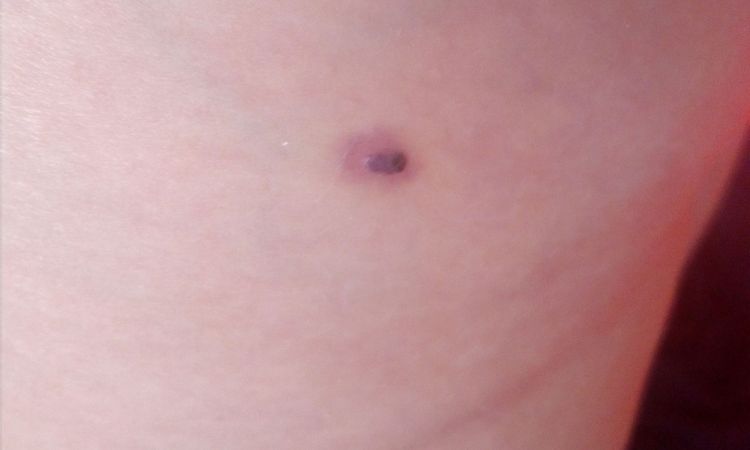 Tmavě červený fliček naplněný krví po porodu, jak léčit? - 13656