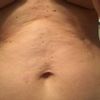 Ochablá kůže po lipotransferu