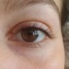 Odstranění pihy na očním víčku - průběh zákroku - 13658