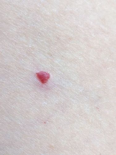 Hrbolek naplněný krví - znaménko nebo ucpaná žilka?