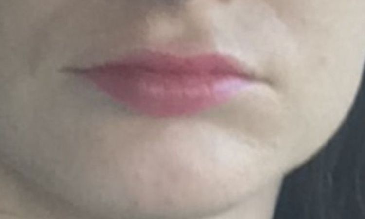 Lip lift (s jizvou přímo u nosu) - 13699