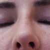 Křivý nos po rhinoplastice - 13782