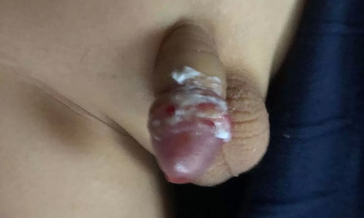 Špatné přetahování předkožky - syn 11 let - 13787