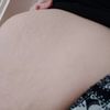 Vydrží břicho s obrovskou diastazou další těhotenství? - 13841