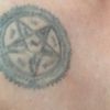 Odstranění tetování a jizvy - 13878