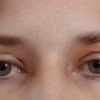 Pocit vykulených očí po operaci víček - 13912