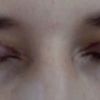 Pocit vykulených očí po operaci víček - 13913