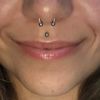 Lip lifting - zkrácení prostoru mezi pusou a nosem - 13928