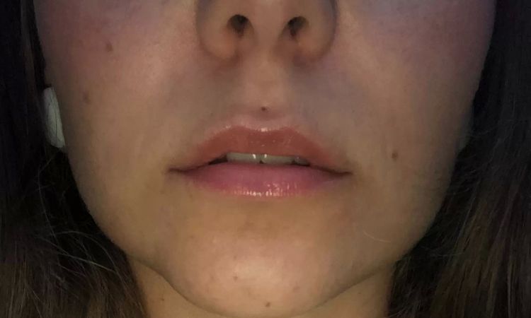 Lip lifting - zkrácení prostoru mezi pusou a nosem - 13931