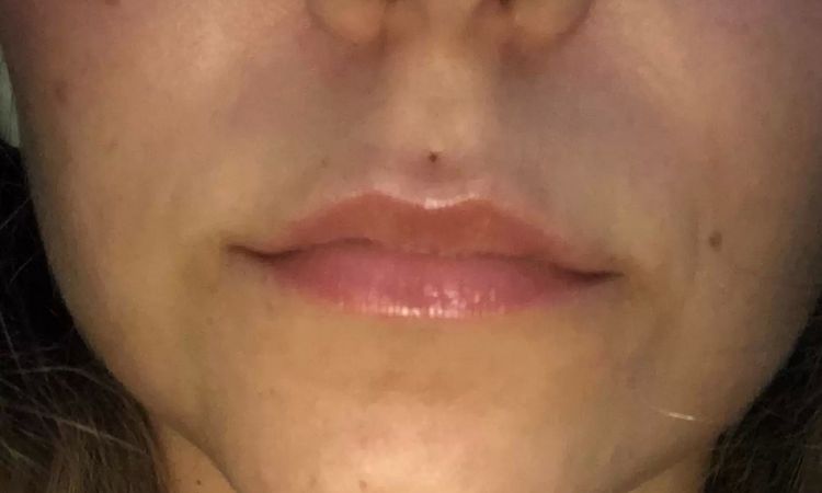 Lip lifting - zkrácení prostoru mezi pusou a nosem - 13933