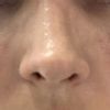 Výška nosních dírek po rhinoplastice - 14048