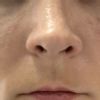 Výška nosních dírek po rhinoplastice - 14049