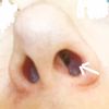 Jak odstranit zjizvení v nose po rhinoplastice - 14061
