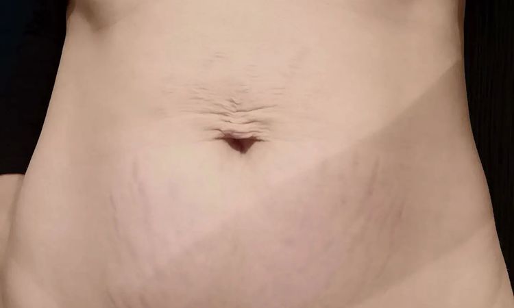 Zjizvená kůže po piercingu - 14211