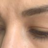 Pomůže blefaroplastika na hezčí a výraznější oči? - 14245