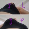 Kapsulotomie - měknutí a tvrdnutí prsa - řešit? - 14265