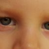 Výrůstky pod očními víčky u 2letého dítěte