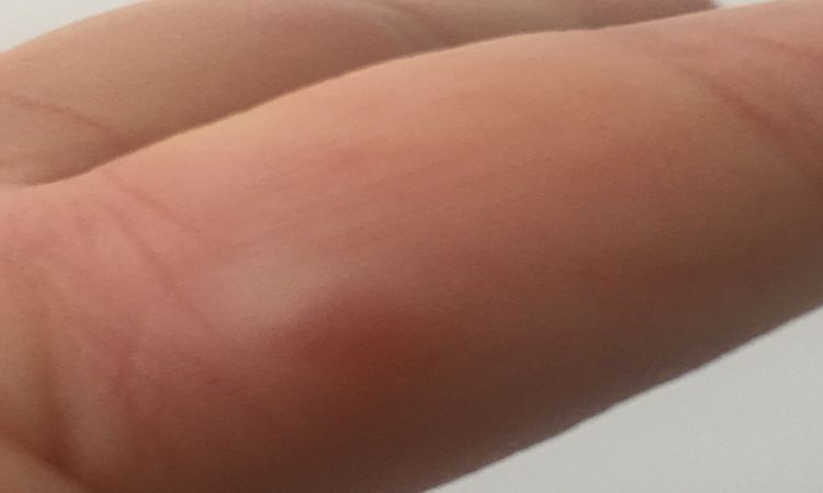 Výrůstek na prstu na ruce - 15133