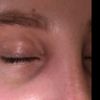 Výstupek vedle oka po kompletní rhinoplastice - 15385
