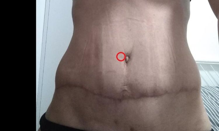 Důlek vedle pupíku po abdominoplastice - 16656