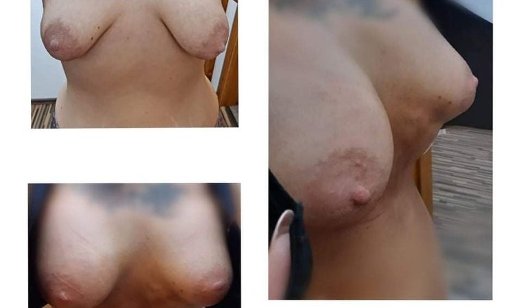 Implantáty Motiva 1050 ml, tubulární prsa - 16775