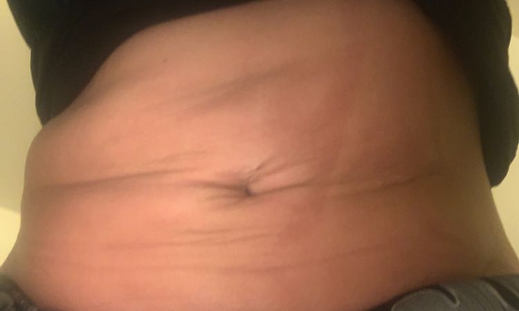 Abdominoplastika stále volná kůže - 32361