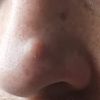 Odstranění cysty na nose - 32431