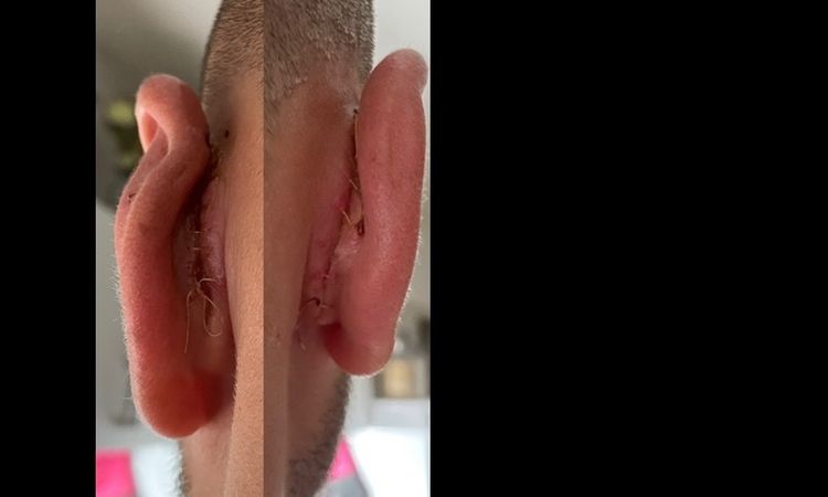 Otoplastika - je to normální? - 32689