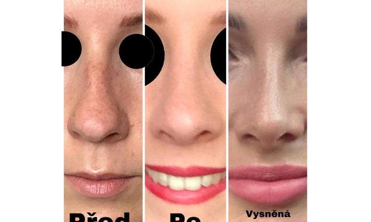 Dobrý výsledek rhinoplastiky? - 32887