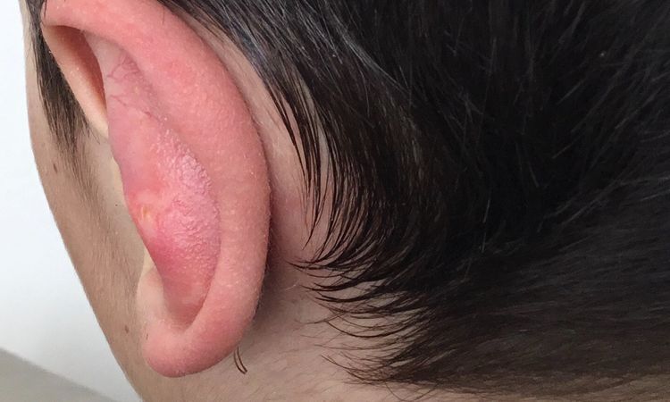 Nepovedená otoplastika dítěte - 32899