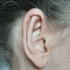 Nevydařená operace uší - 33072