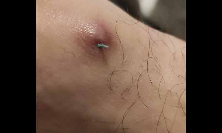 Rok po operaci žil mi z nohou lezou provázky - 33236