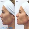 Korekce obrysu dolní čelisti a zvětšení brady výplněmi, t.z. "profil Jolie"