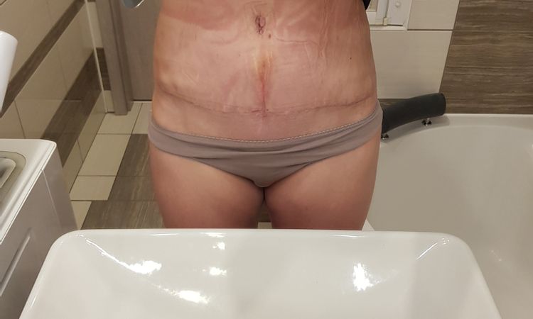 Vystouple bricho po abdominoplastice - 42798
