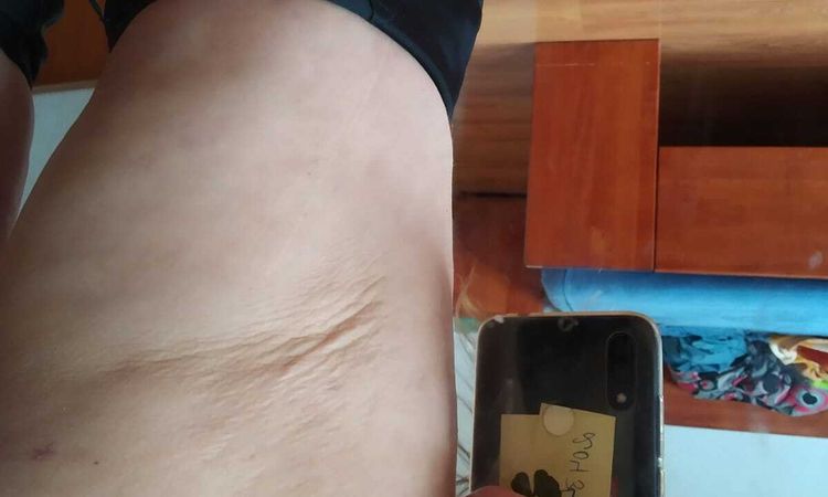 Povolená kůže po liposukci stehen - 43499
