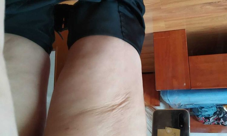 Povolená kůže po liposukci stehen - 43500
