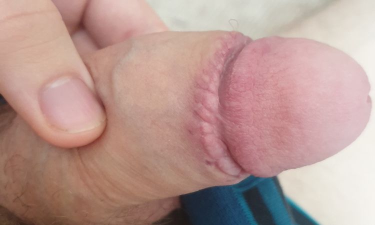 Hrbolky na jizvě po obřízce - 43778