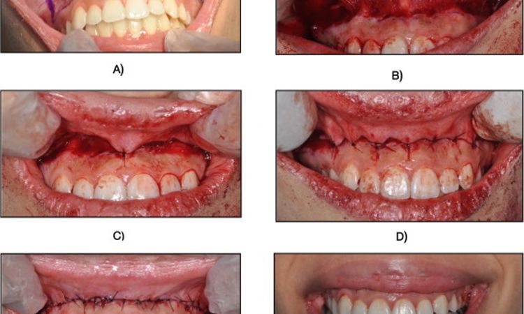 Posun rtu, gingivoplastika - 43945