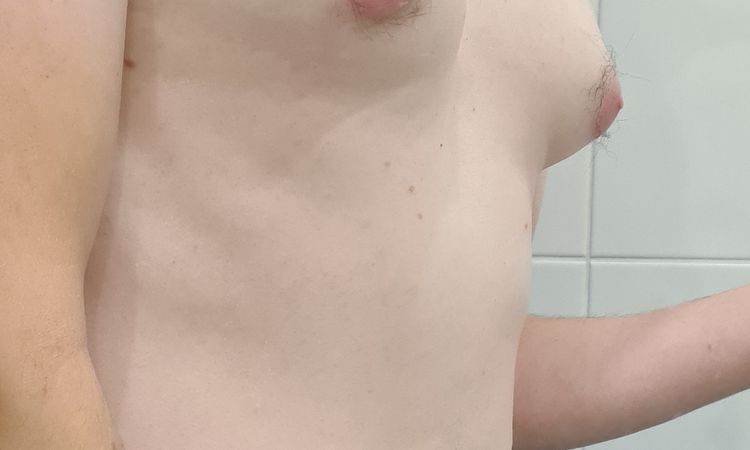 Velikost prsní žlázy jako indikace k odstranění gynekomastie - 44784