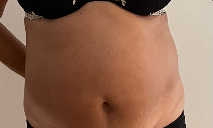 12 dní po abdominoplastice mám stejné břicho jako před operací - 45382