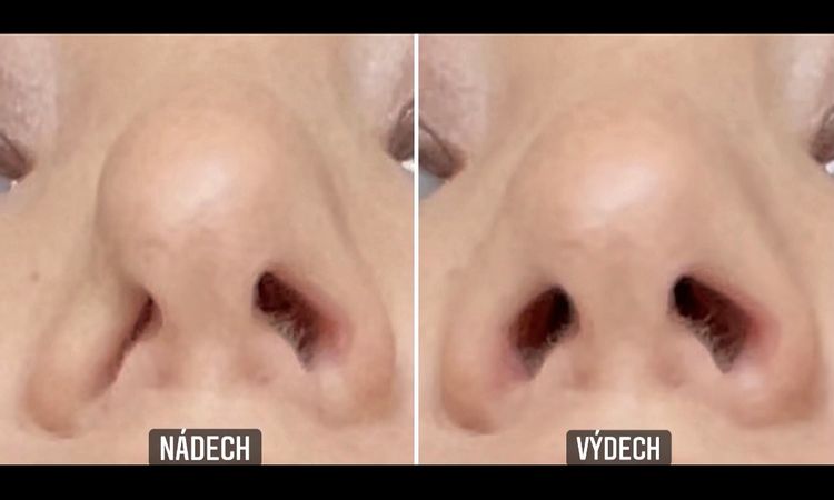 Problém s dýcháním po rhinoplastice + foto - 46130
